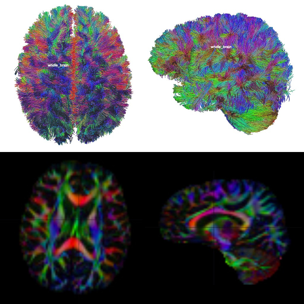 Diffusion Tensor Imaging (DTI)